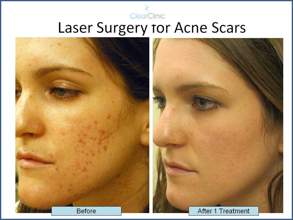 tobak glemsom i stedet Treating Post-Pimple Redness, Laser Treatments for Red Spots From Acne
