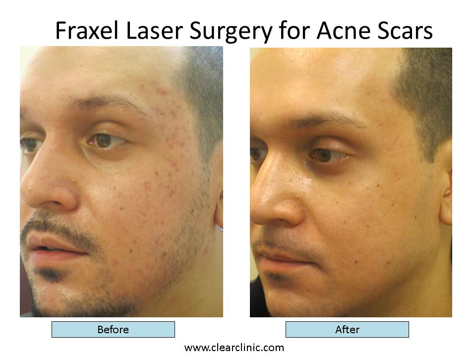 The Five Things You Should Know About Fraxel Acne Scar ...