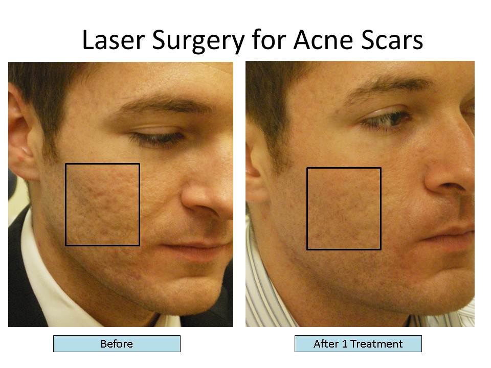 The Best Lasers to Treat Acne Scars, Fractional CO2 Laser, Fraxel