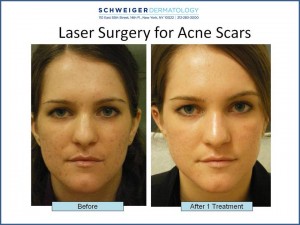CO2 Laser Treatment New York Acne Scars