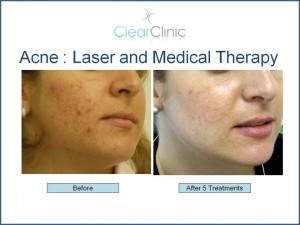 Medical and Laser Acne Treatments
