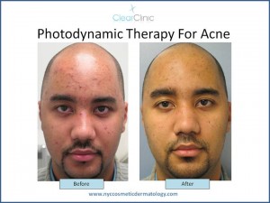 Moderate Acne Package at Clear Clinic NYC