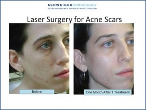 STRONGEST LASER TREATMENT FOR ACNE SCARS IS ROHRER AESTHETICS FULLY  ABLATIVE CO2