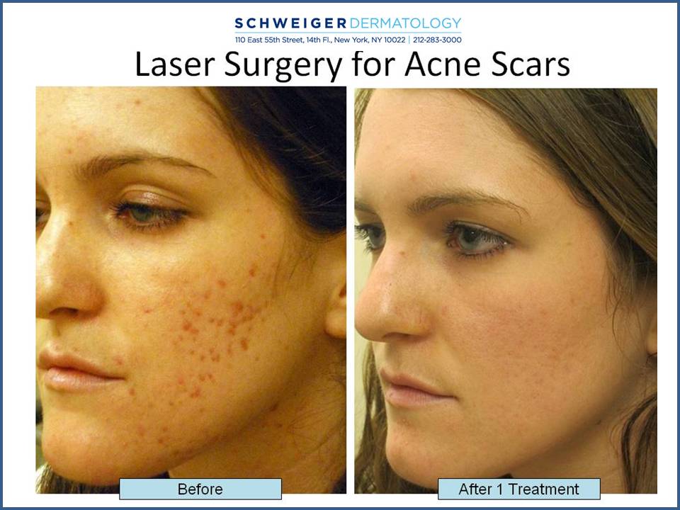 How Can Get Rid Of Red Marks From Acne? KTP Laser for Acne NYC
