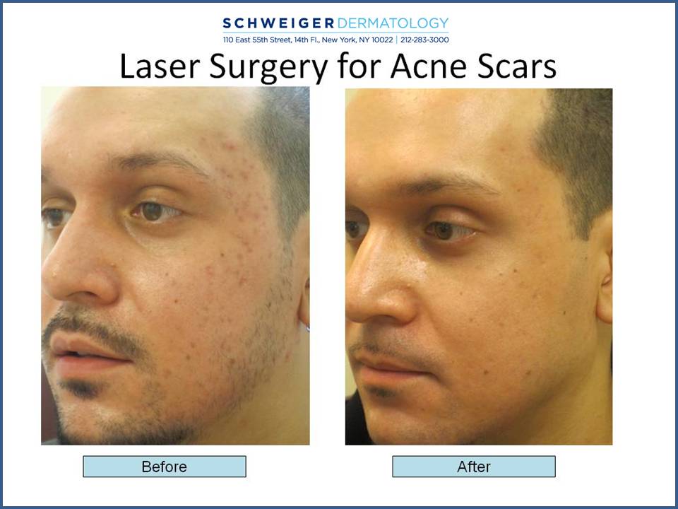 sorg Udstyr bande Red Marks From Old Acne, Laser Treatment for Acne Scars, NYC Derm acne