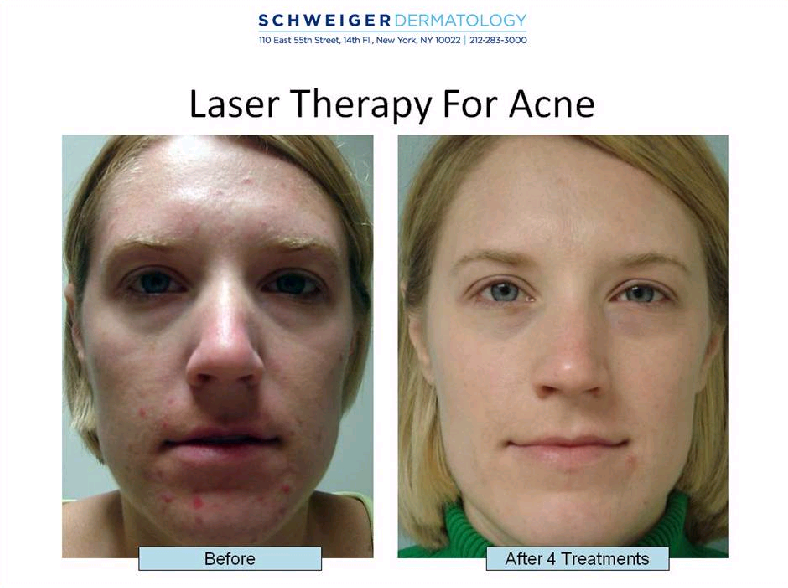 The Difference Therapy and Blue Light Therapy for Acne