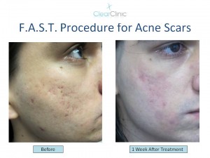 Acne Scar Treatment in NYC with FAST Technique