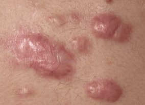 keloid-acne-scars-best-treatment