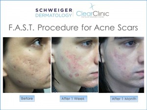 clear-skin-program-fast-treatment-for-acne-scars