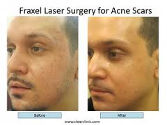 fraxel-for-acne-scars-acne-scar-expert-ny