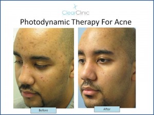 Photodynamic-Acne-Therapy-NYC