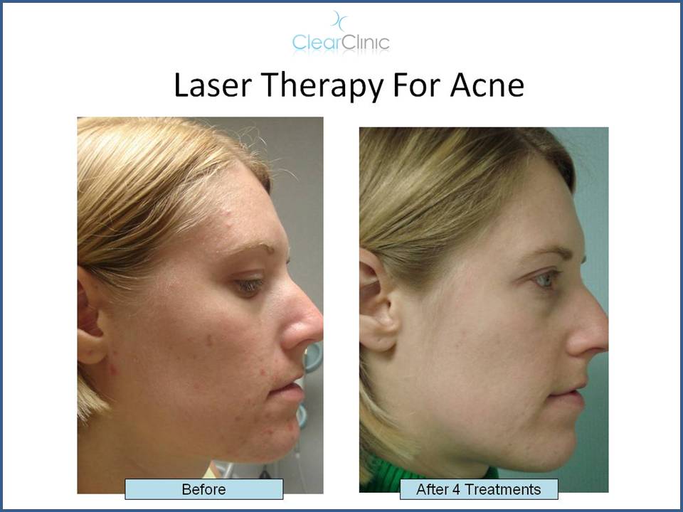 do-hormones-cause-acne-laser-treatment-ny