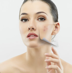 Woman With Acne