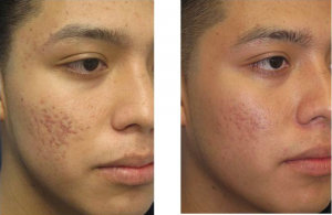laser acne scar removal