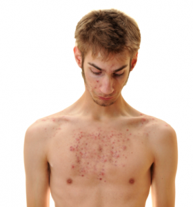 Dealing with Chest Acne